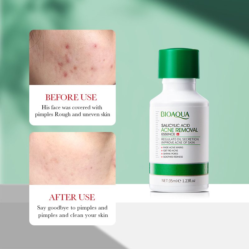 35ml BIOAOUA Salicylic Acid An - Azelaic Acid Serum review and price