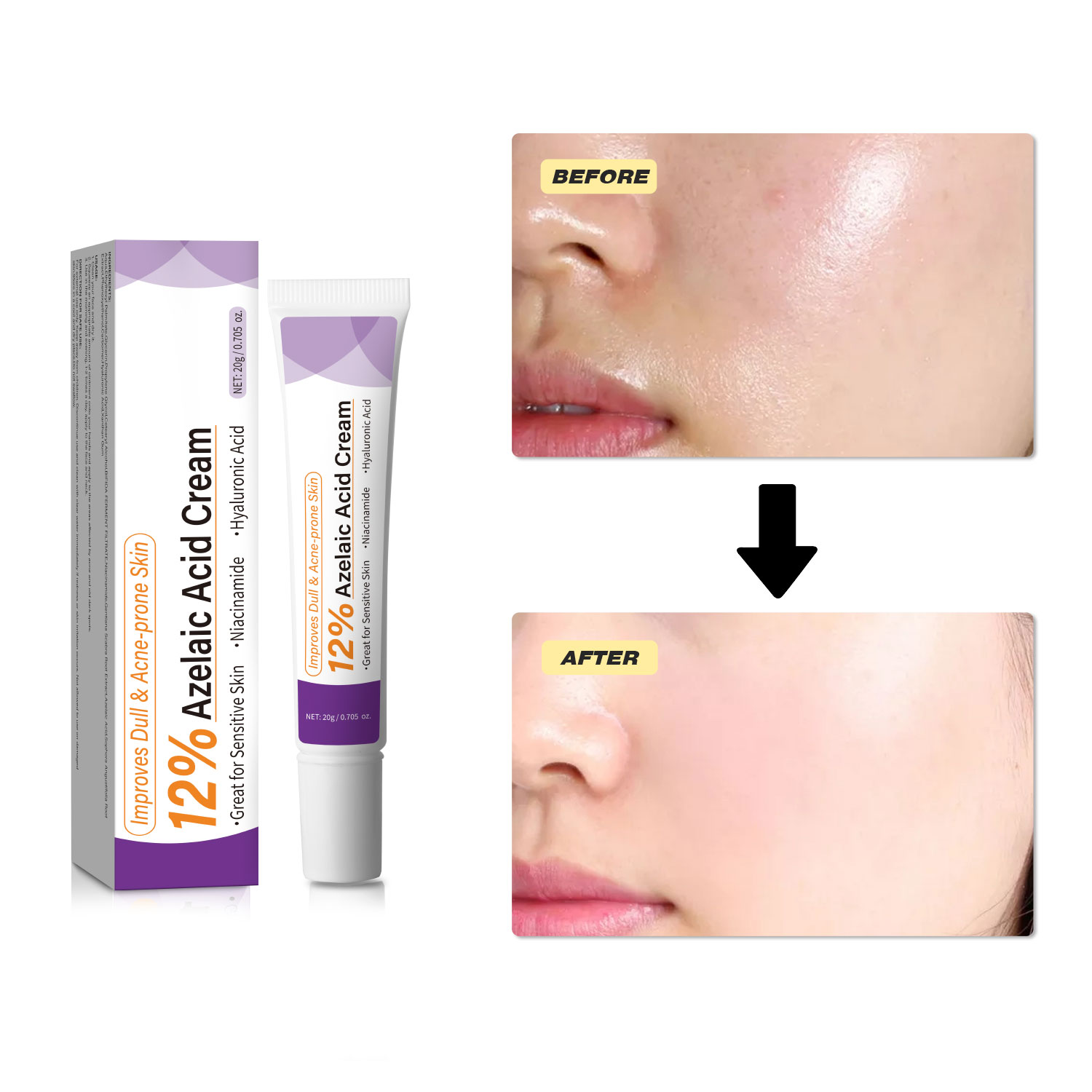 Mild Azelaic Acid Cream Improv - Azelaic Acid Serum review and price